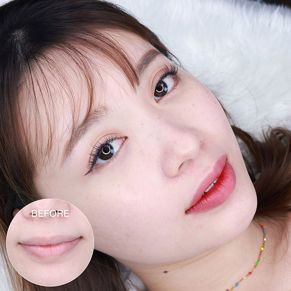 có nên cấy môi sinh học không