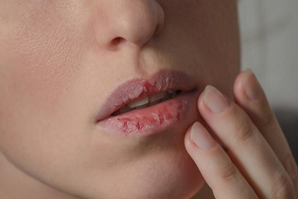 không được bóc lớp vảy khi môi đang bong