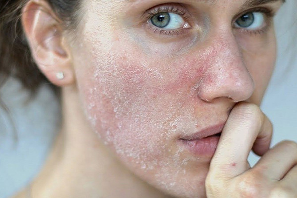 da mặt khô là gì