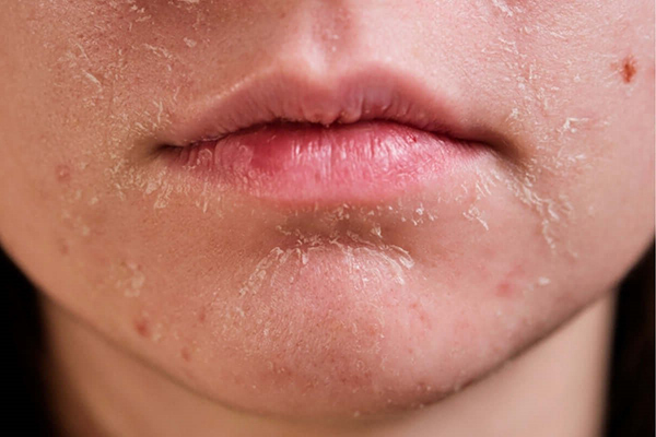 da mặt khô nên dùng gì