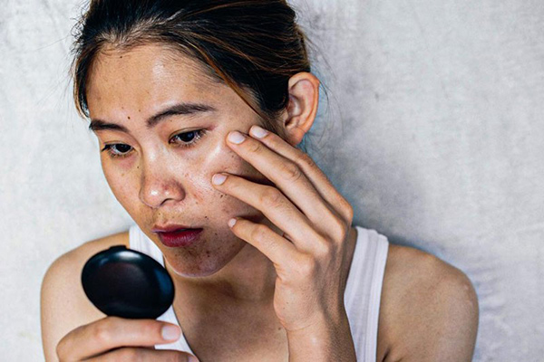 da mặt không đều màu