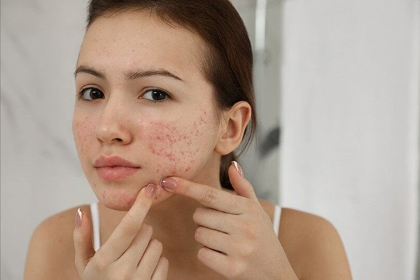 lưu ý khi điều trị mụn chai