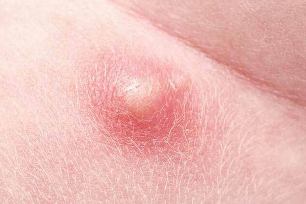 mụn chai xuất hiện trên lưng bụng mông