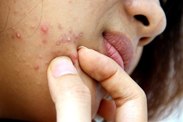 nguyên nhân hình thành mụn chai