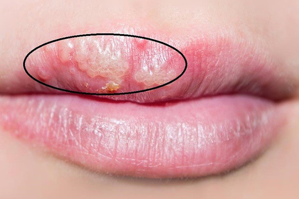 những nguy hiểm sau khi phun môi