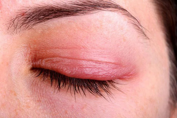 vì sao nối mi bị ngứa mắt