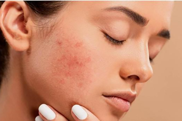 tác hại của sợi bã nhờn