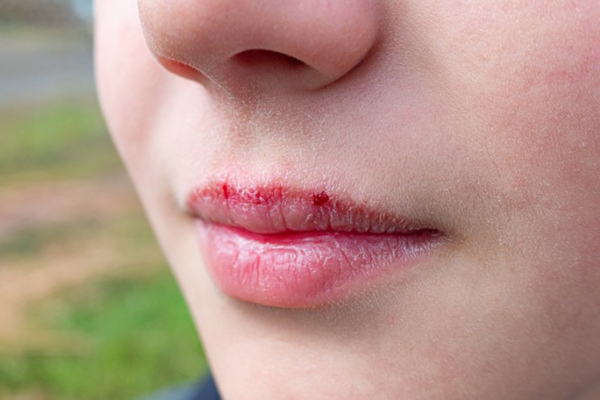 khô môi có nguy hiểm không