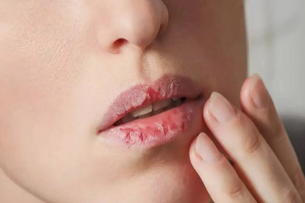 môi khô nứt nẻ là nỗi ám ảnh của nhiều người