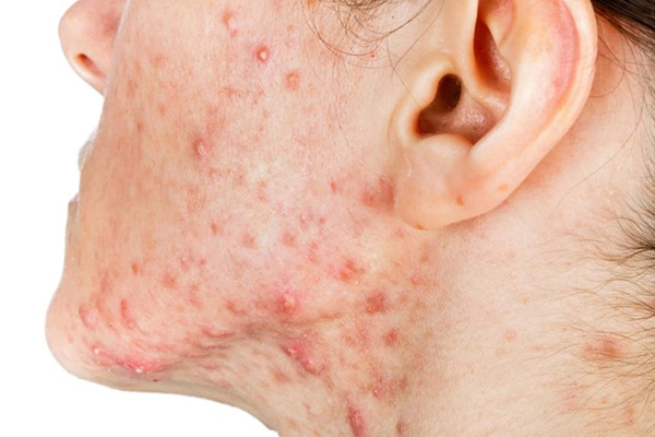 xông mặt bằng tỏi cải thiện mụn ẩn và mụn viên