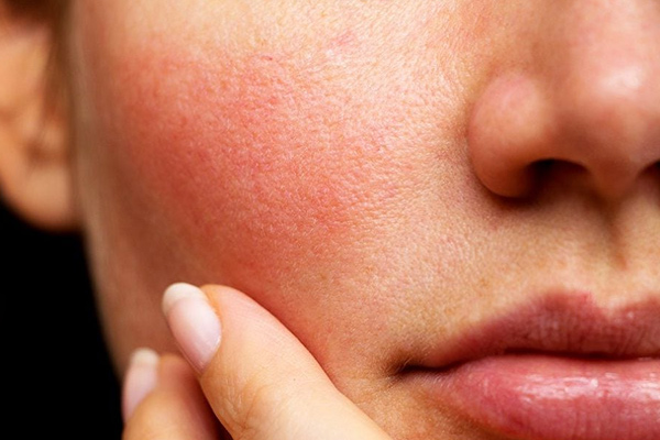 xông mặt bằng tỏi có gây kích ứng không