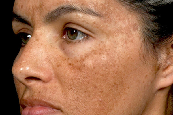 xông mặt bằng tỏi có trị được nám không