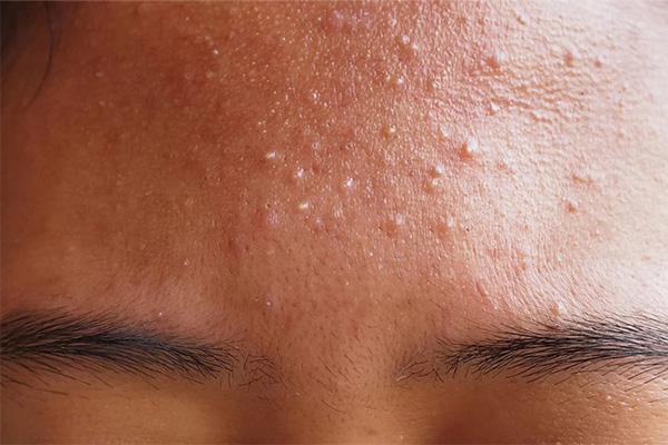 Cách Nhận Biết Mụn Ẩn