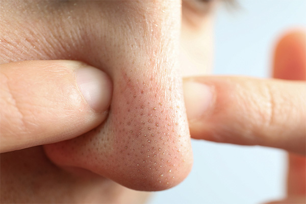 đẩy mụn ẩn dưới da là gì