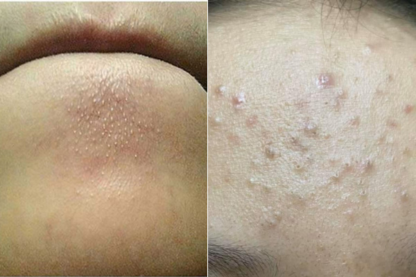 mụn ẩn là gì